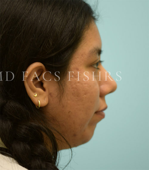 Rhinoplasty-Nose Job Case 38528 After Photo Rhinoplasty-Nose Job