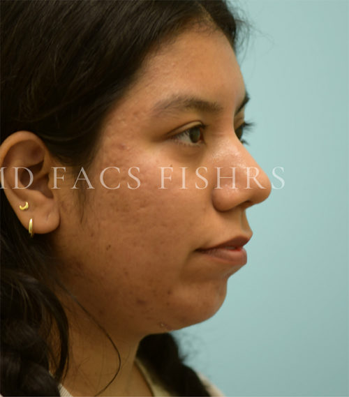 Rhinoplasty-Nose Job Case 38526 After Photo Rhinoplasty-Nose Job