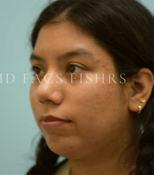 Rhinoplasty-Nose Job Case 38520 After Photo Rhinoplasty-Nose Job