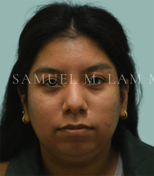 Rhinoplasty-Nose Job Case 38523 Before Photo Rhinoplasty-Nose Job