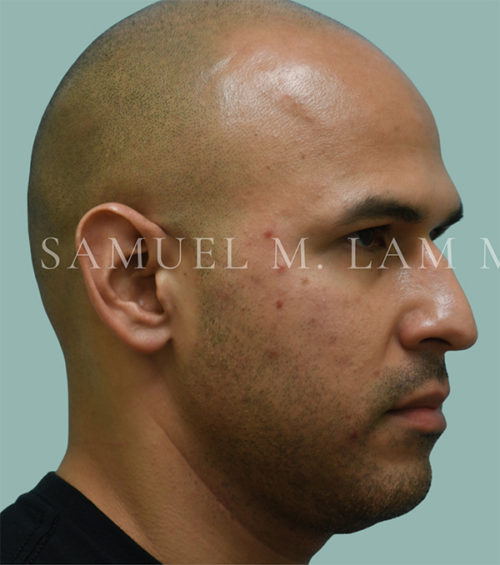 Otoplasty (Cosmetic Ear Reshaping) Case 38556 Before Photo Otoplasty (Cosmetic Ear Reshaping)