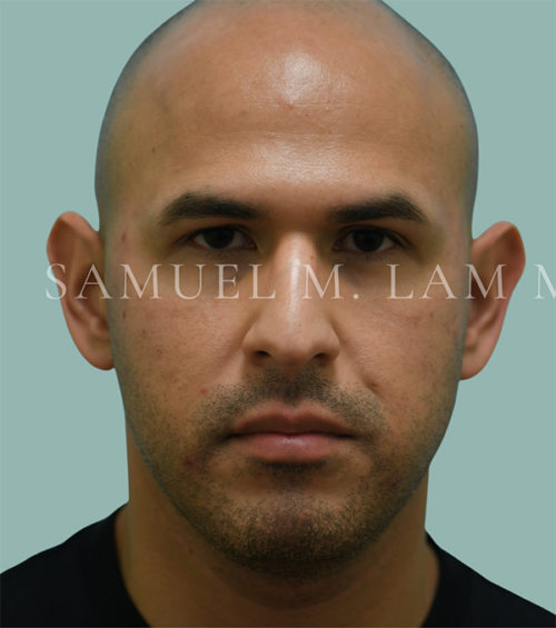 Otoplasty (Cosmetic Ear Reshaping) Case 38552 Before Photo Otoplasty (Cosmetic Ear Reshaping)