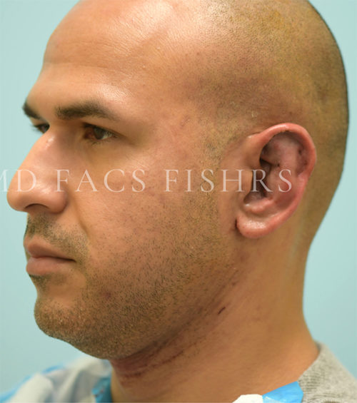 Otoplasty (Cosmetic Ear Reshaping) Case 38551 After Photo Otoplasty (Cosmetic Ear Reshaping)