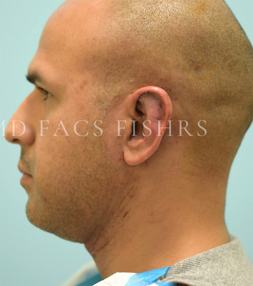 Otoplasty (Cosmetic Ear Reshaping) Case 38555 After Photo Otoplasty (Cosmetic Ear Reshaping)