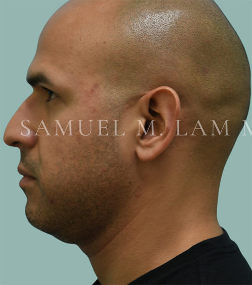 Otoplasty (Cosmetic Ear Reshaping) Case 38554 Before Photo Otoplasty (Cosmetic Ear Reshaping)