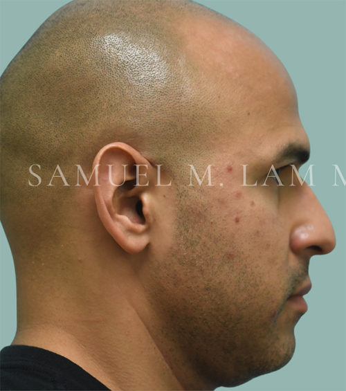 Otoplasty (Cosmetic Ear Reshaping) Case 38558 Before Photo Otoplasty (Cosmetic Ear Reshaping)