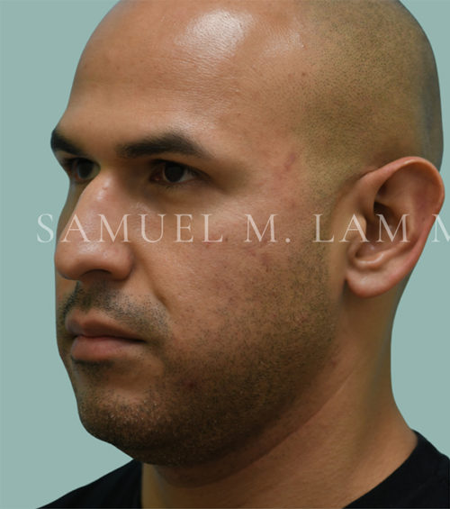 Otoplasty (Cosmetic Ear Reshaping) Case 38550 Before Photo Otoplasty (Cosmetic Ear Reshaping)