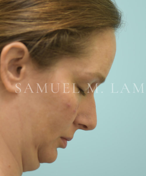 Facelift/Neck Lift Case 39696 Before Photo Facelift/Neck Lift