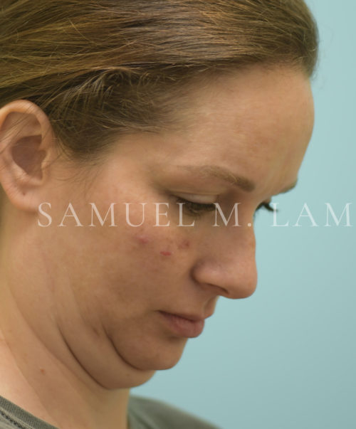 Facelift/Neck Lift Case 39695 Before Photo Facelift/Neck Lift