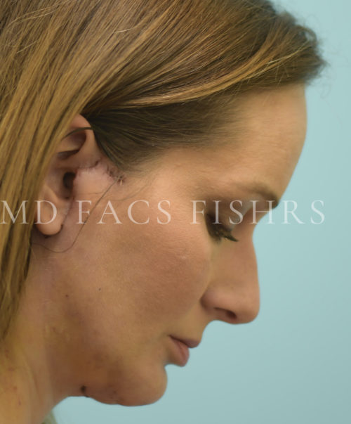 Facelift/Neck Lift Case 39699 After Photo Facelift/Neck Lift