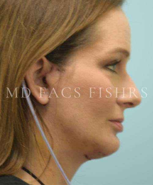 Facelift/Neck Lift Case 39697 After Photo Facelift/Neck Lift