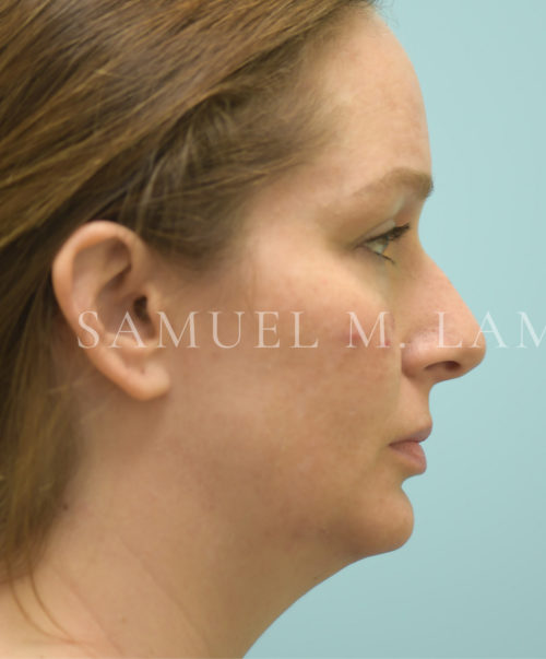 Facelift/Neck Lift Case 39694 Before Photo Facelift/Neck Lift