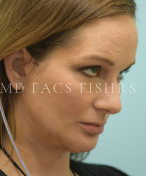 Facelift/Neck Lift Case 39698 After Photo Facelift/Neck Lift