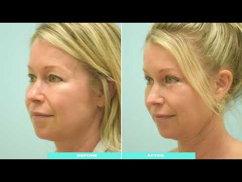 Dallas Cosmetic Surgery | Upper Eyelid Blepharoplasty  | Patient Testimonial