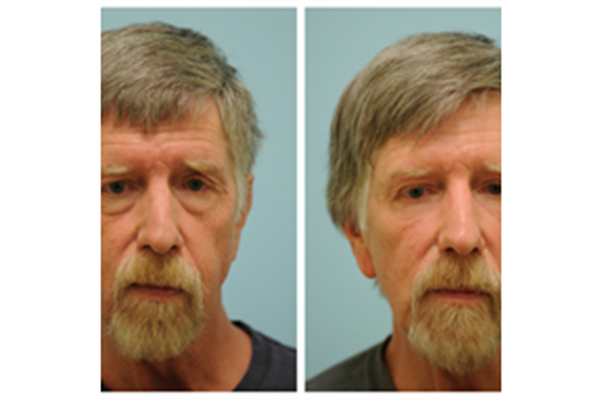 Before and After Photos - Blepharoplasty