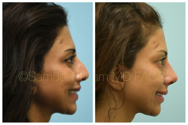 Rhinoplasty