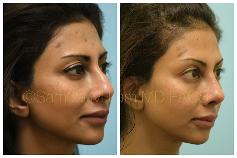 Rhinoplasty