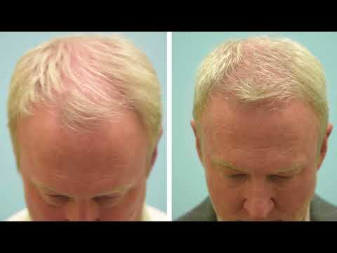 Upper and Lower Blepharoplasty/Fat Grafting/Hair Transplant Testimonial with Before and After Photos