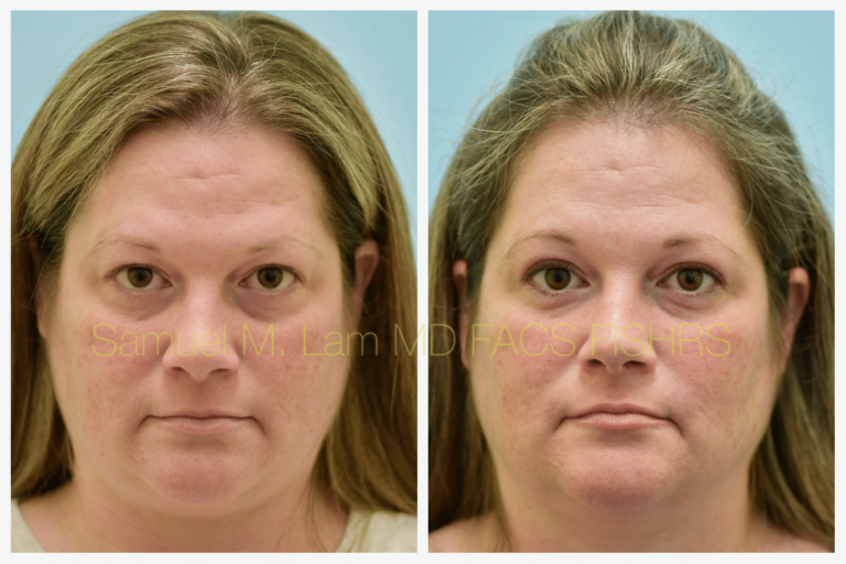 blepharoplasty before and after
