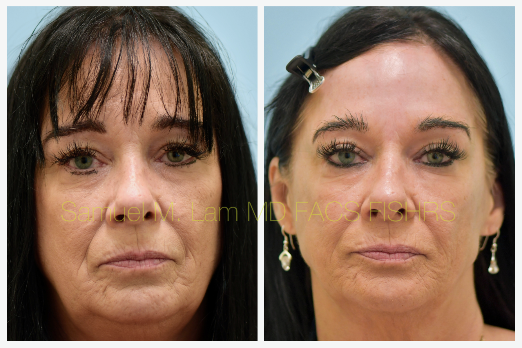 Dallas Botox Before and After Photos - Plano Plastic Surgery Photo Gallery  - Dr. Sam LamBotox Archives