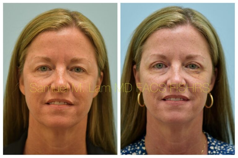 Blepharoplasty Before and After Photo - Dr. Sam Lam - Dallas, TX