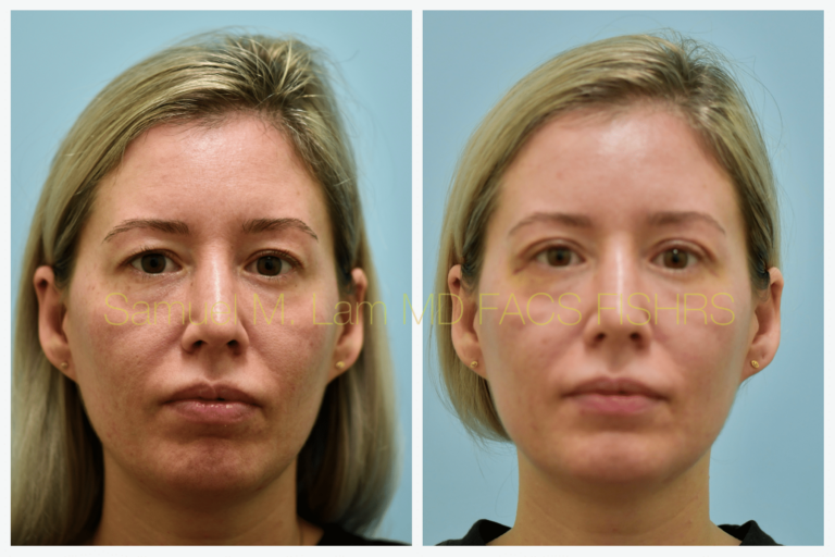 Dr Lams blepharoplasty Bxa