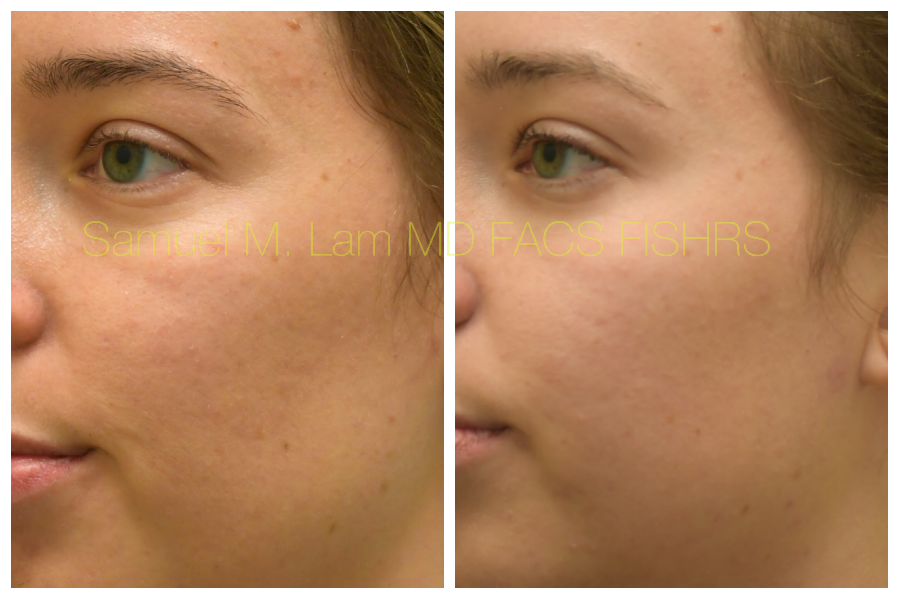 Dallas Botox Before and After Photos - Plano Plastic Surgery Photo Gallery  - Dr. Sam LamBotox Archives