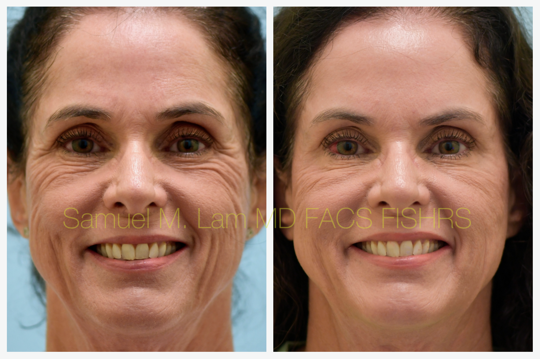 Dallas Botox Before and After Photos - Plano Plastic Surgery Photo Gallery  - Dr. Sam LamBotox Archives