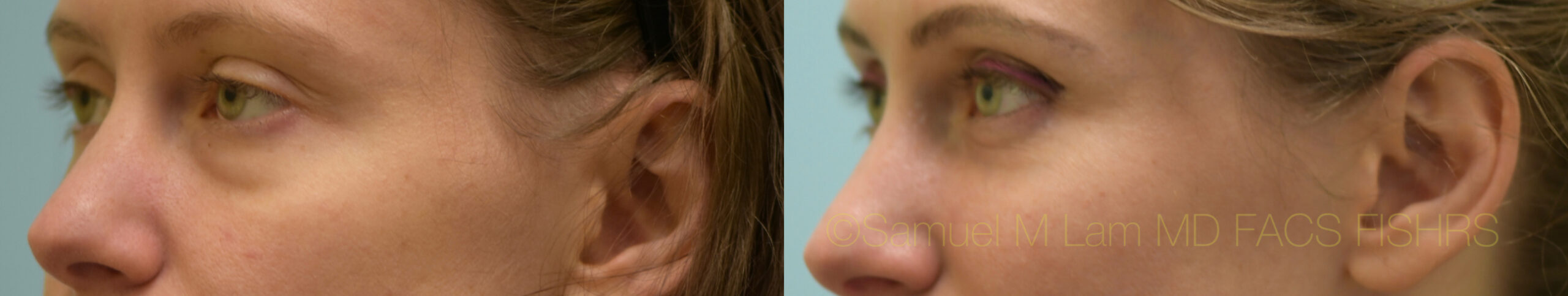 Eyelid Rejuvenation, Fat Grafting