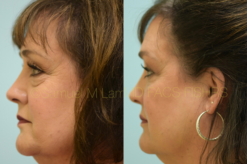 Eyelid Rejuvenation, Fat Grafting