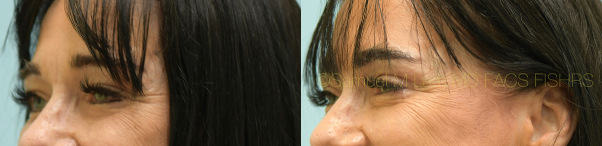 Eyelid Rejuvenation