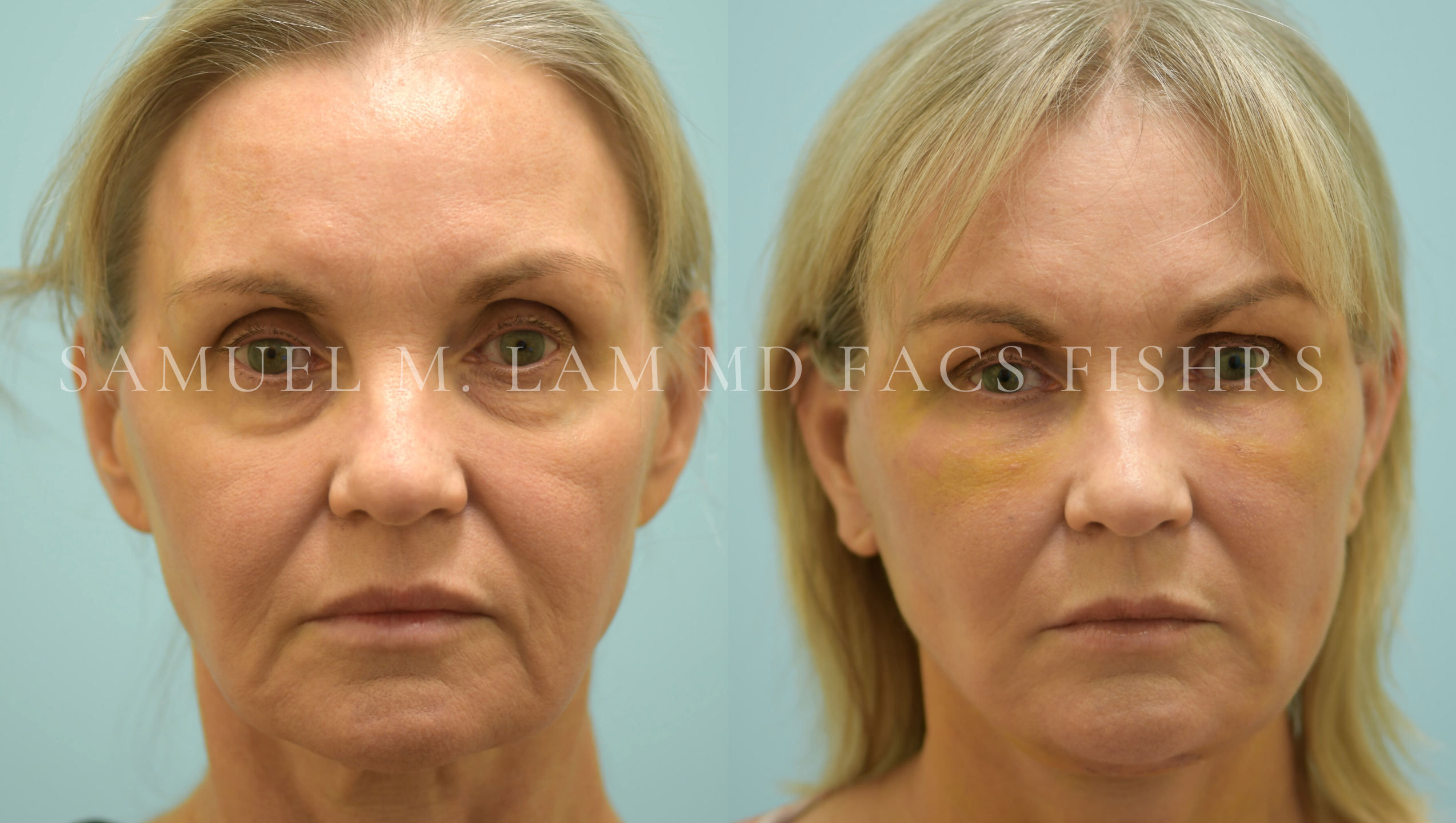 Facelift/Neck Lift