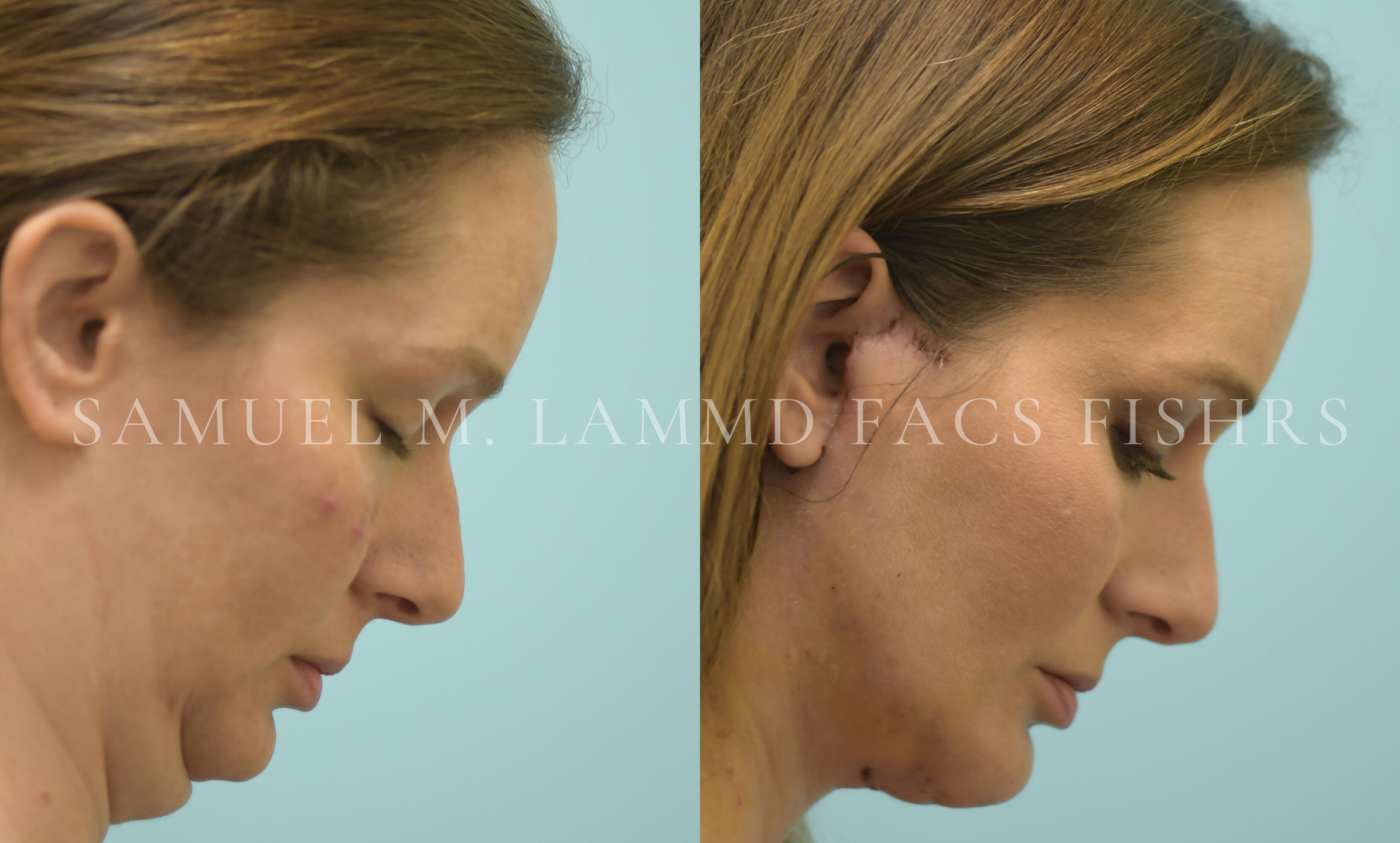 Facelift/Neck Lift