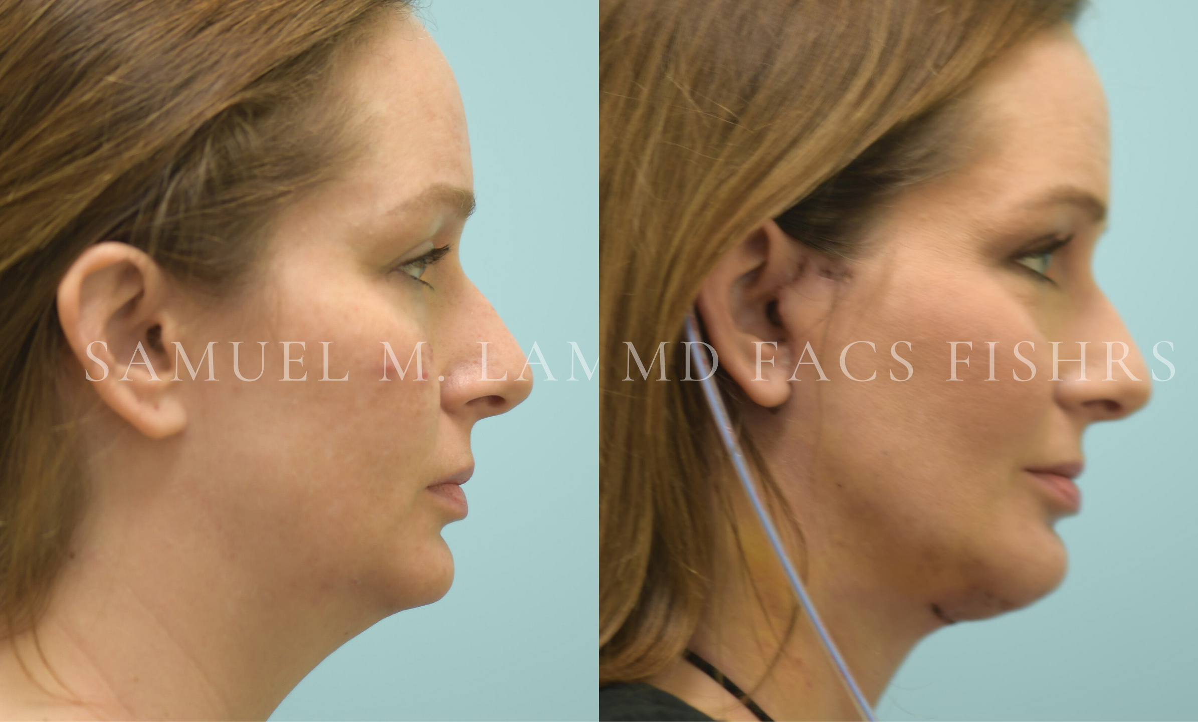 Facelift/Neck Lift