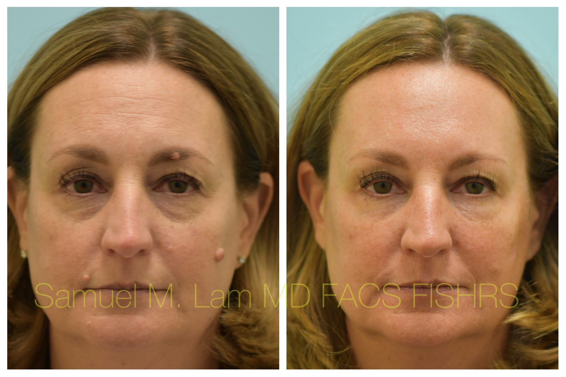 mole removal cream before and after