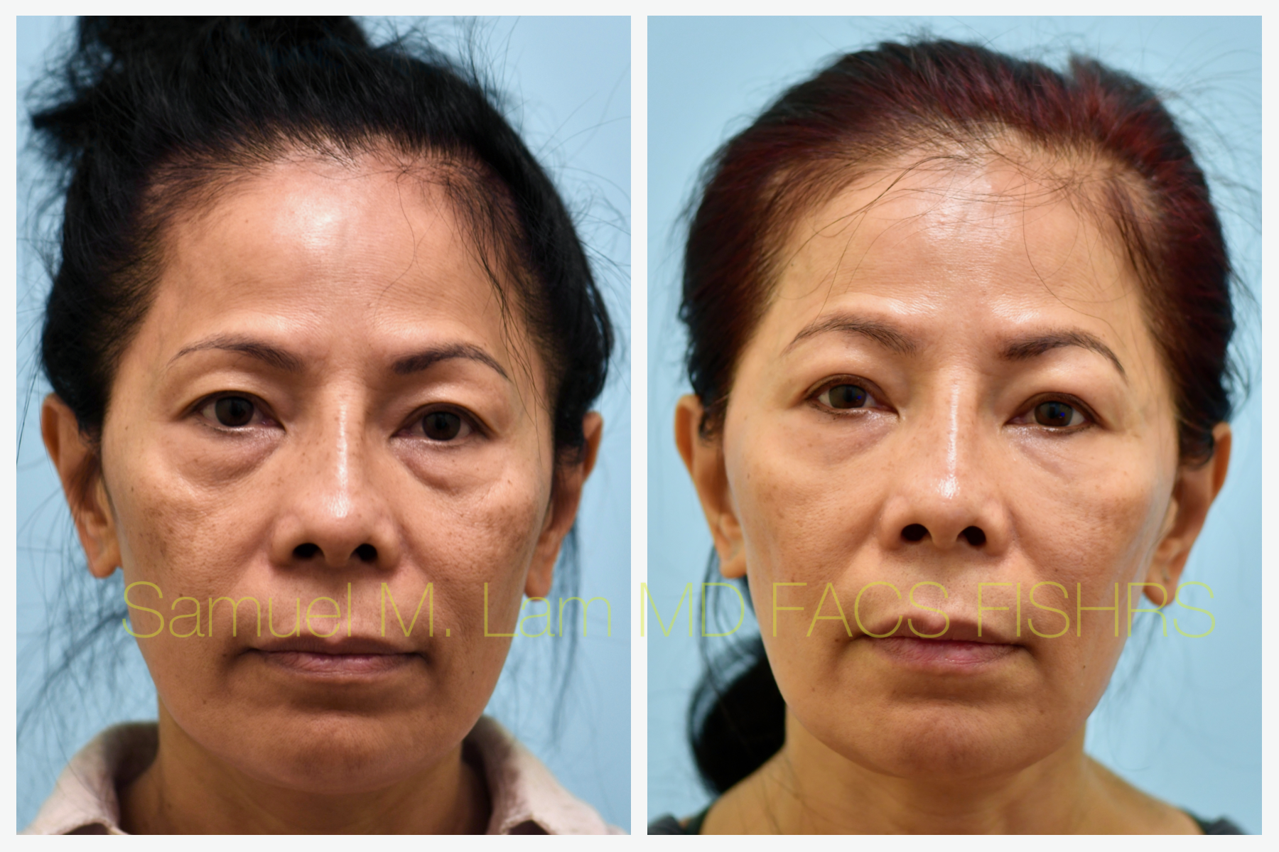 Facial Fat Transfer