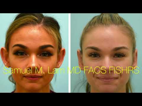 Dallas Otoplasty Testimonial and Before-and After Results