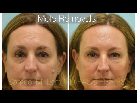 7 Mole Removal Testimonial in Dallas,Texas One Year After