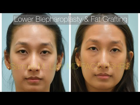 Lower Blepharoplasty & Fat Grafting Testimonial with Dr. Lam in Dallas, Texas