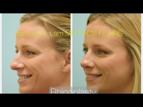 Dallas Rhinoplasty Testimonial for a Crooked Nose with Hump and Tip Refinement with Photos