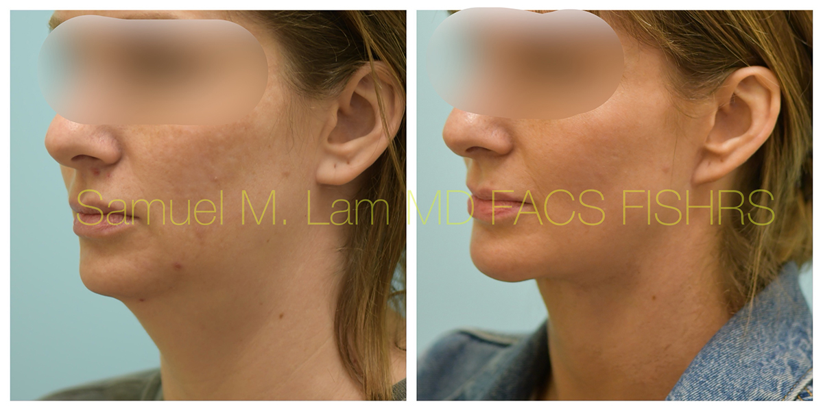 Facelift and Chin Implant Before and After Photo by Dr. Lam in Plano, TX