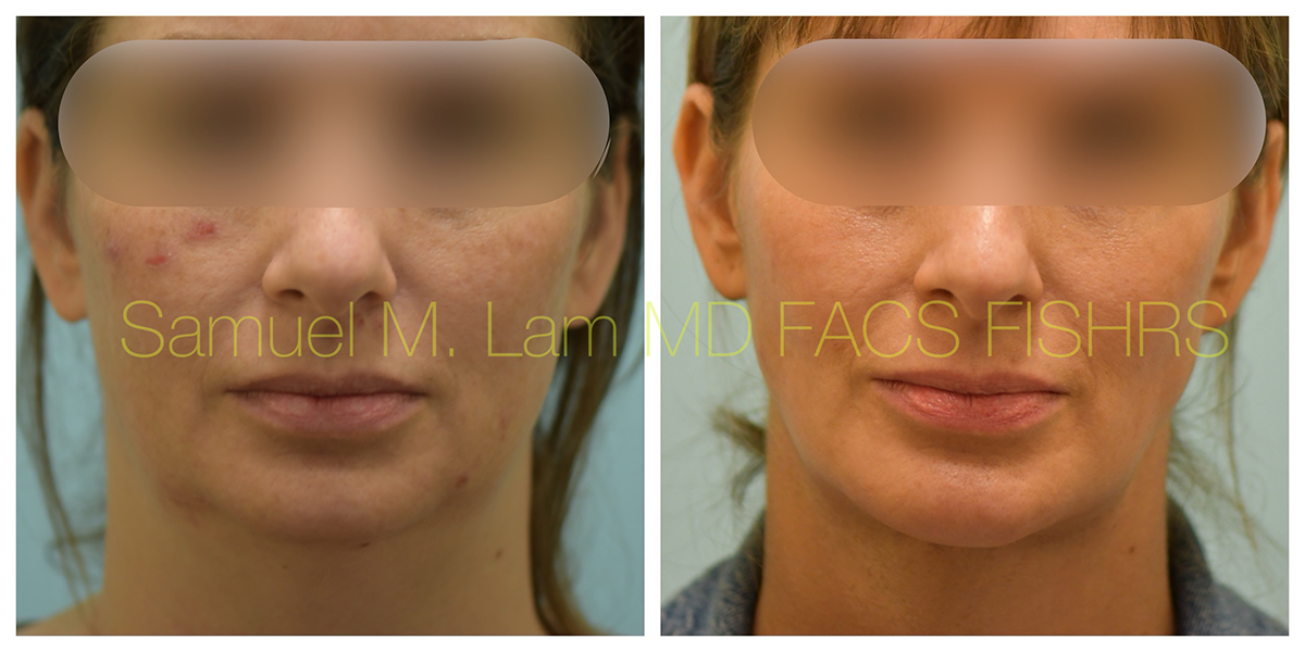 Facelift and Chin Implant Before and After Photo by Dr. Lam in Plano, TX