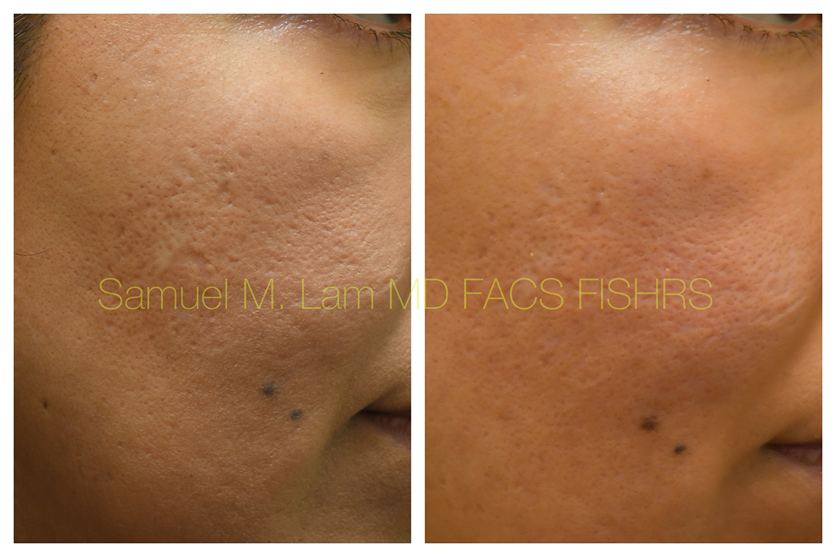 Acne Scarring Before and After Photo by Dr. Lam in Plano, TX