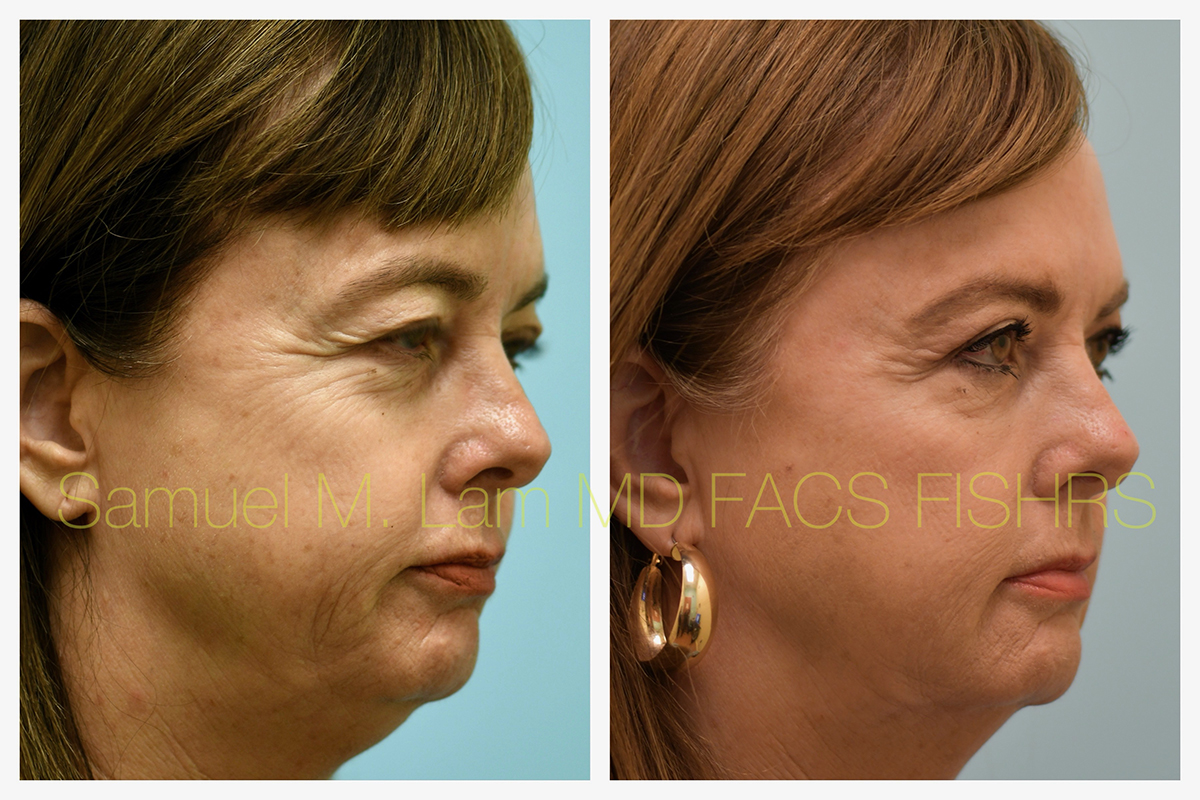 Eyelid Rejuvenation, Botox, and Fillers Before and After Photo by Dr. Lam in Plano, TX