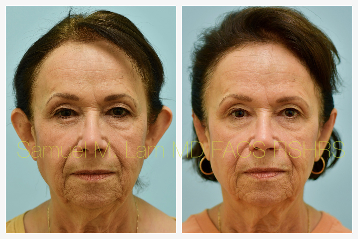 Otoplasty Before and After Photo by Dr. Lam in Plano, TX