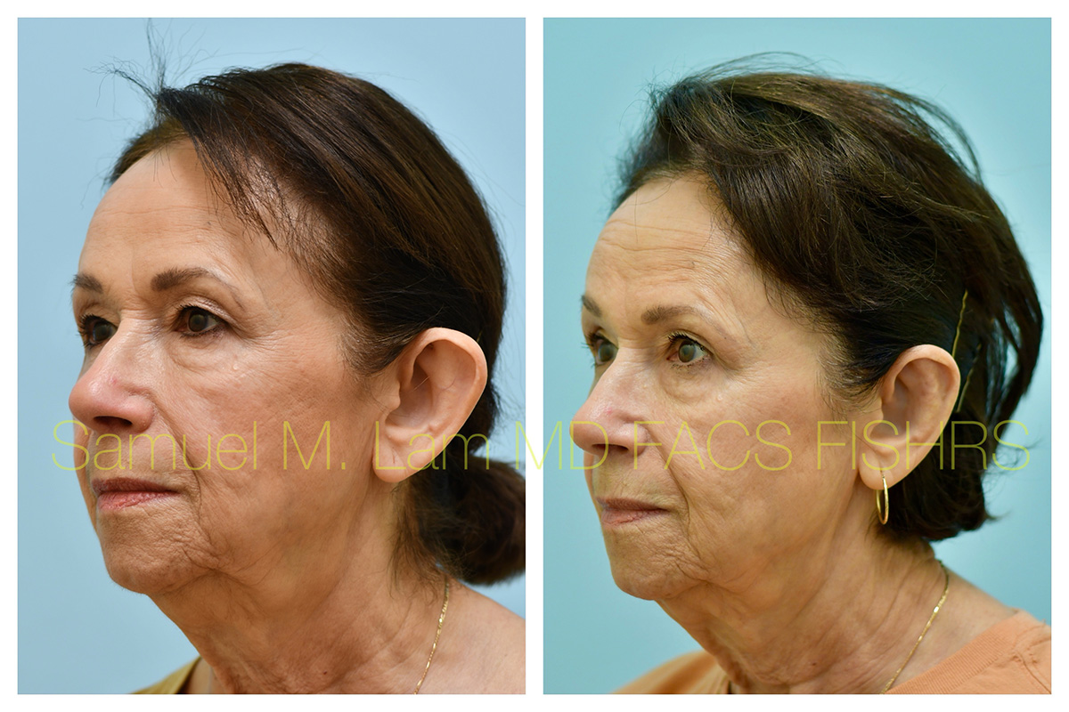 Otoplasty Before and After Photo by Dr. Lam in Plano, TX