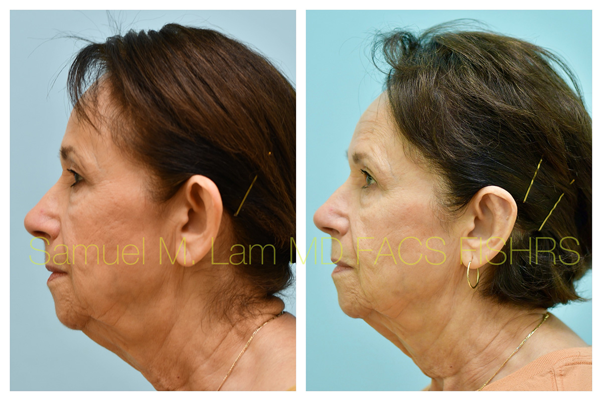 Otoplasty Before and After Photo by Dr. Lam in Plano, TX