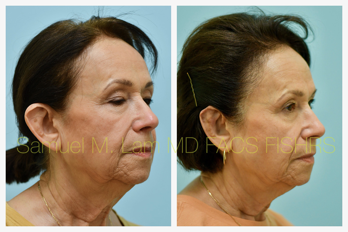 Otoplasty Before and After Photo by Dr. Lam in Plano, TX