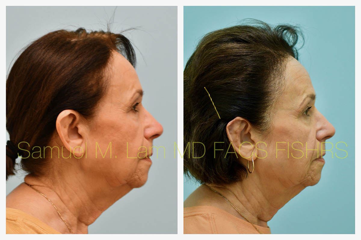 Otoplasty Before and After Photo by Dr. Lam in Plano, TX