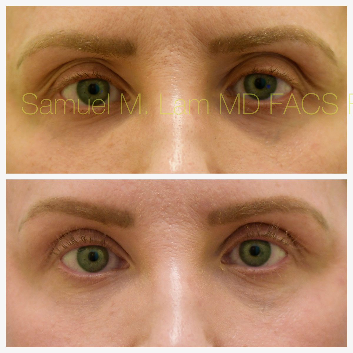 Blepharoplasty, eyelid rejuvenation Before and After Photo by Dr. Lam in Plano, TX